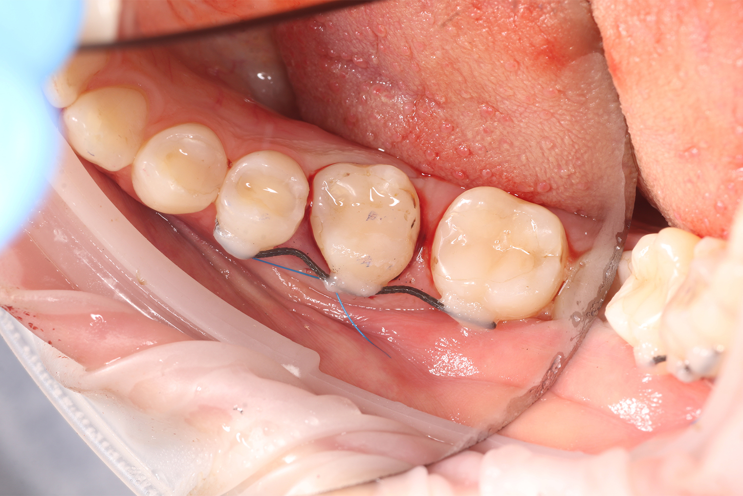 Так выглядит зуб после пересадки, сбоку видно проволочный ретейнер