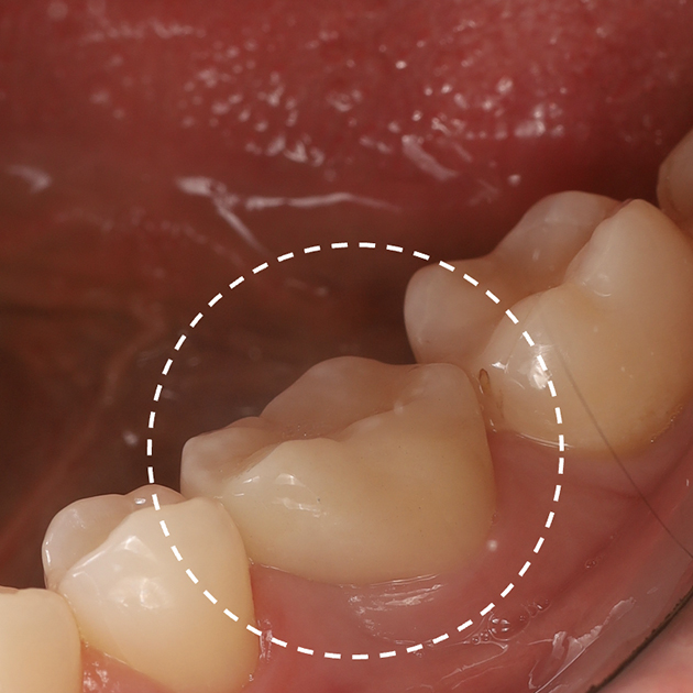 Финальный результат аутотрансплантации через восемь недель после операции: пересаженный зуб депульпировали, а затем установили коронку для сохранения функций и эстетики зубного ряда