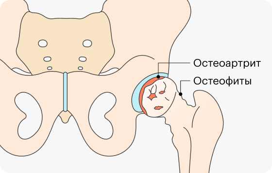 При остеоартрите организм пытается восстановить сустав, усиливает выработку коллагена, но это не помогает