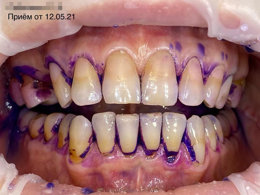 Фиолетовые пятна у корней и между зубами — зоны, которым в процессе ежедневной гигиены уделяется недостаточное внимание