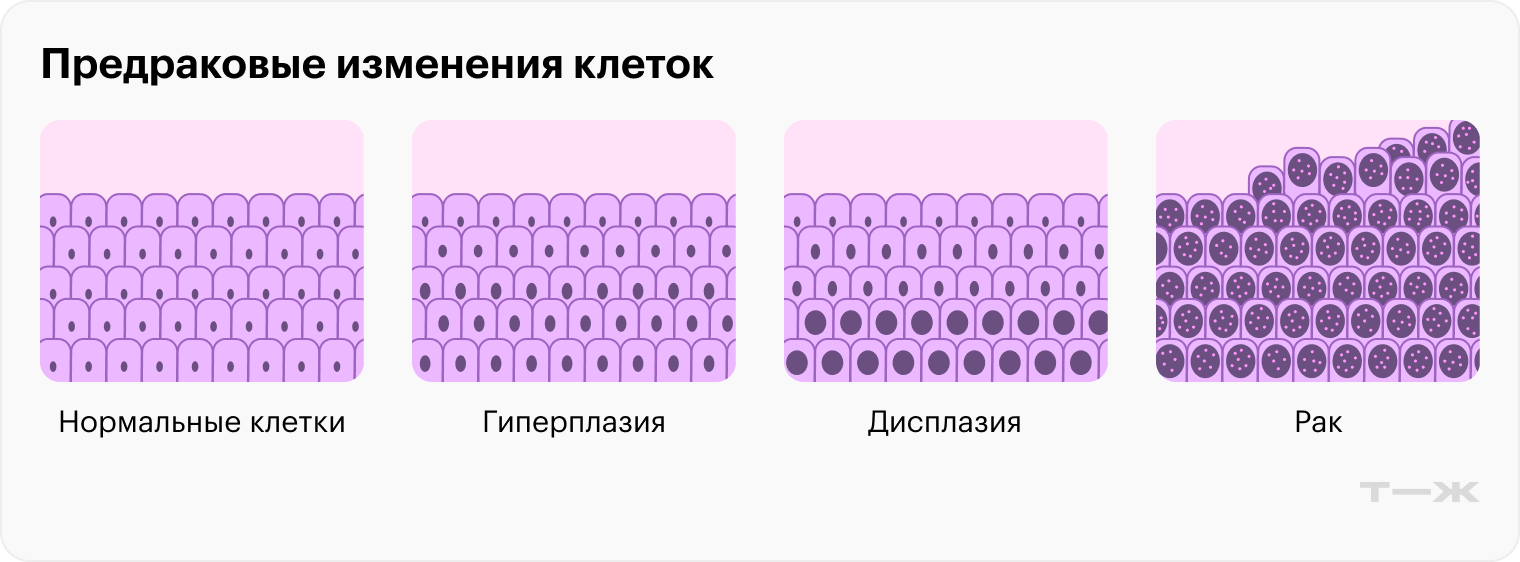 При гиперплазии клеток становится больше, но под микроскопом они выглядят нормально, а при дисплазии клетки теряют свою нормальную структуру. Иногда эти состояния переходят в рак