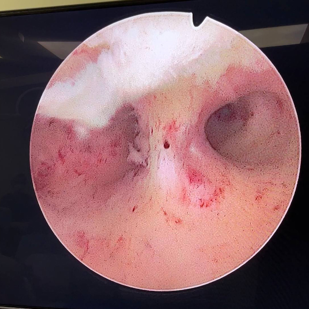 Синехия внутри полости матки во время гистерорезектоскопии