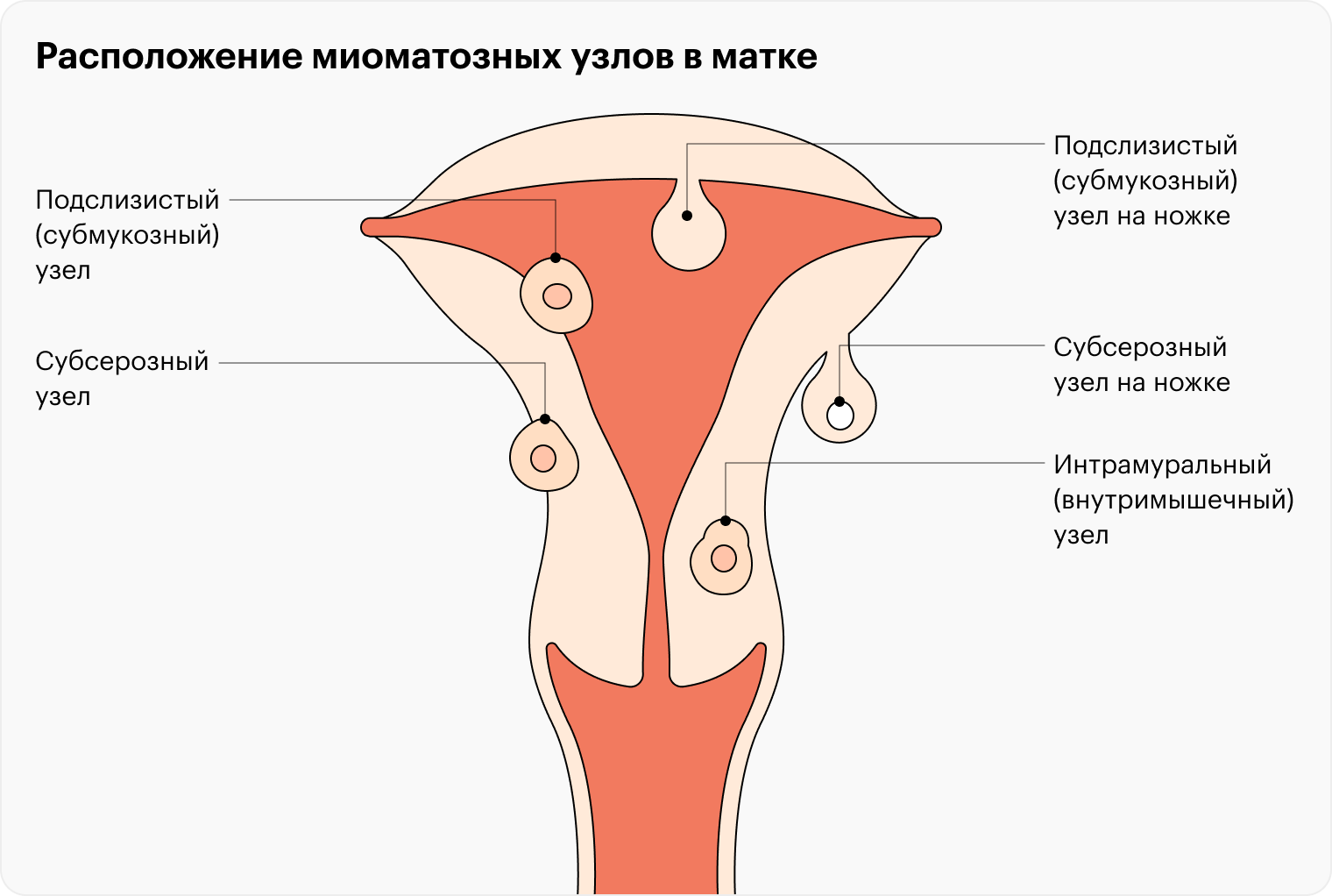 Лечение миомы матки в 21 веке — Городская Больница №40