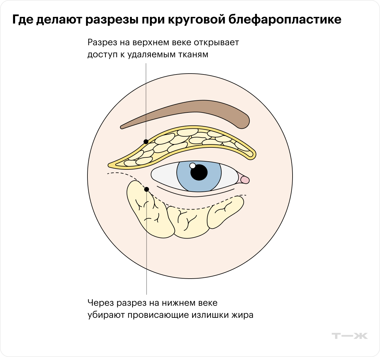 При круговой блефаропластике на самом деле одновременно проводят две разные операции — на верхнем и нижнем веке