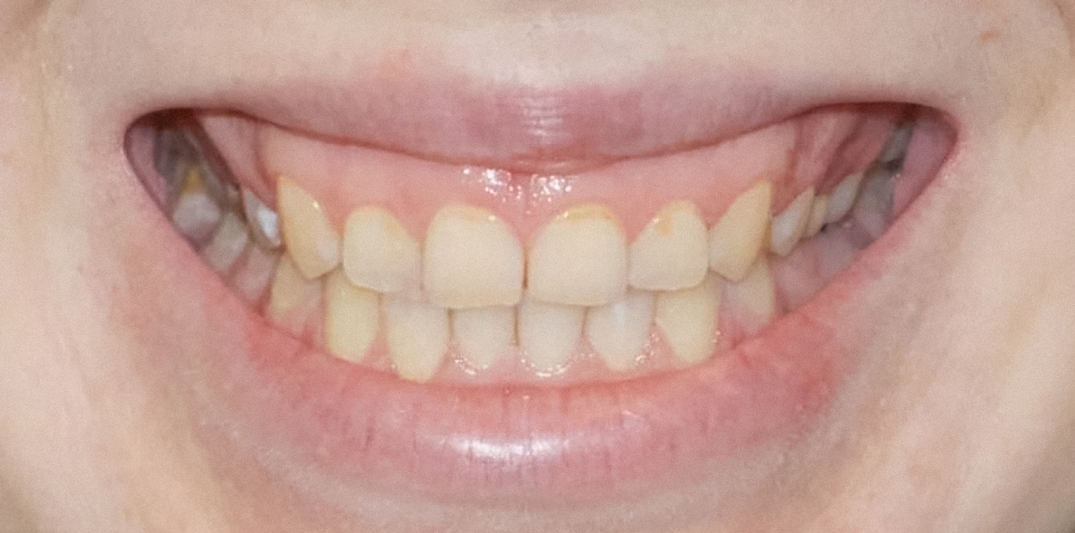 Зубы до лечения