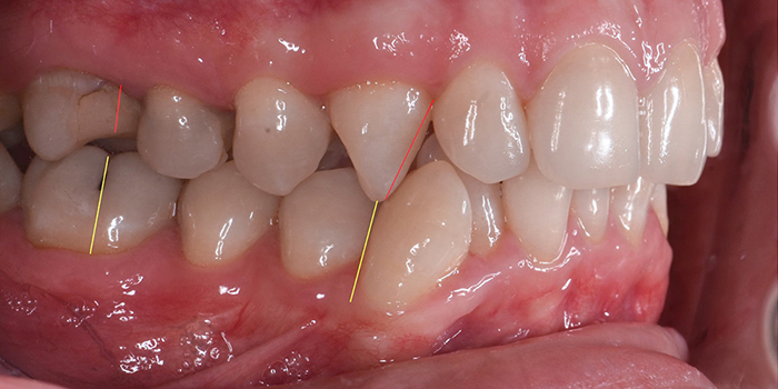 Вид зубов сбоку. С помощью желтых и красных линий врач объясняла, что с зубами не так и в какую сторону их будут двигать