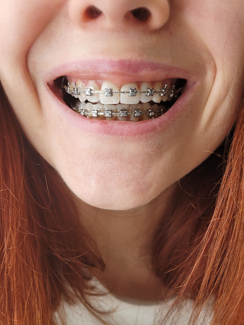 На какие зубы ставят брекеты? - Стоматология «Королевство Улыбок»