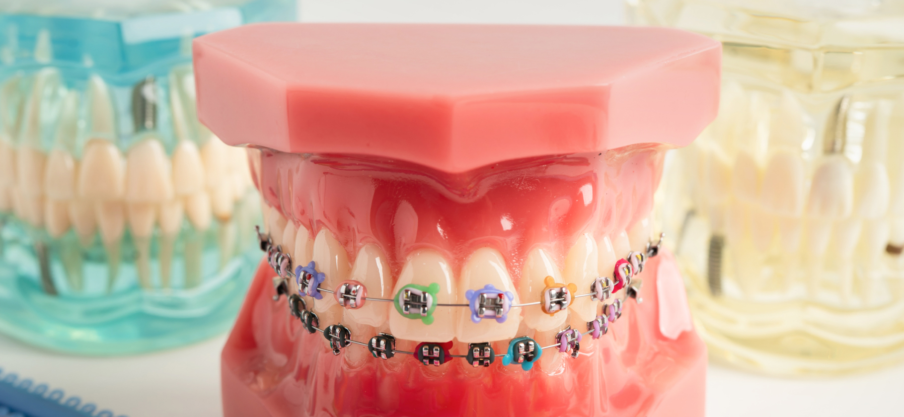 «Не узнал свое отра­жение в зеркале»: 4 истории о лечении брекетами после 35 лет