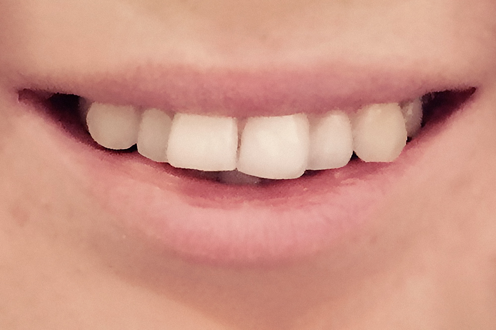 Зубы до лечения