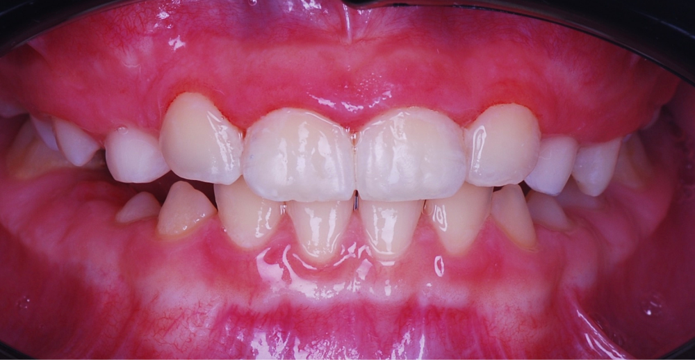 После ортодонтического лечения ребенка с молочными зубами