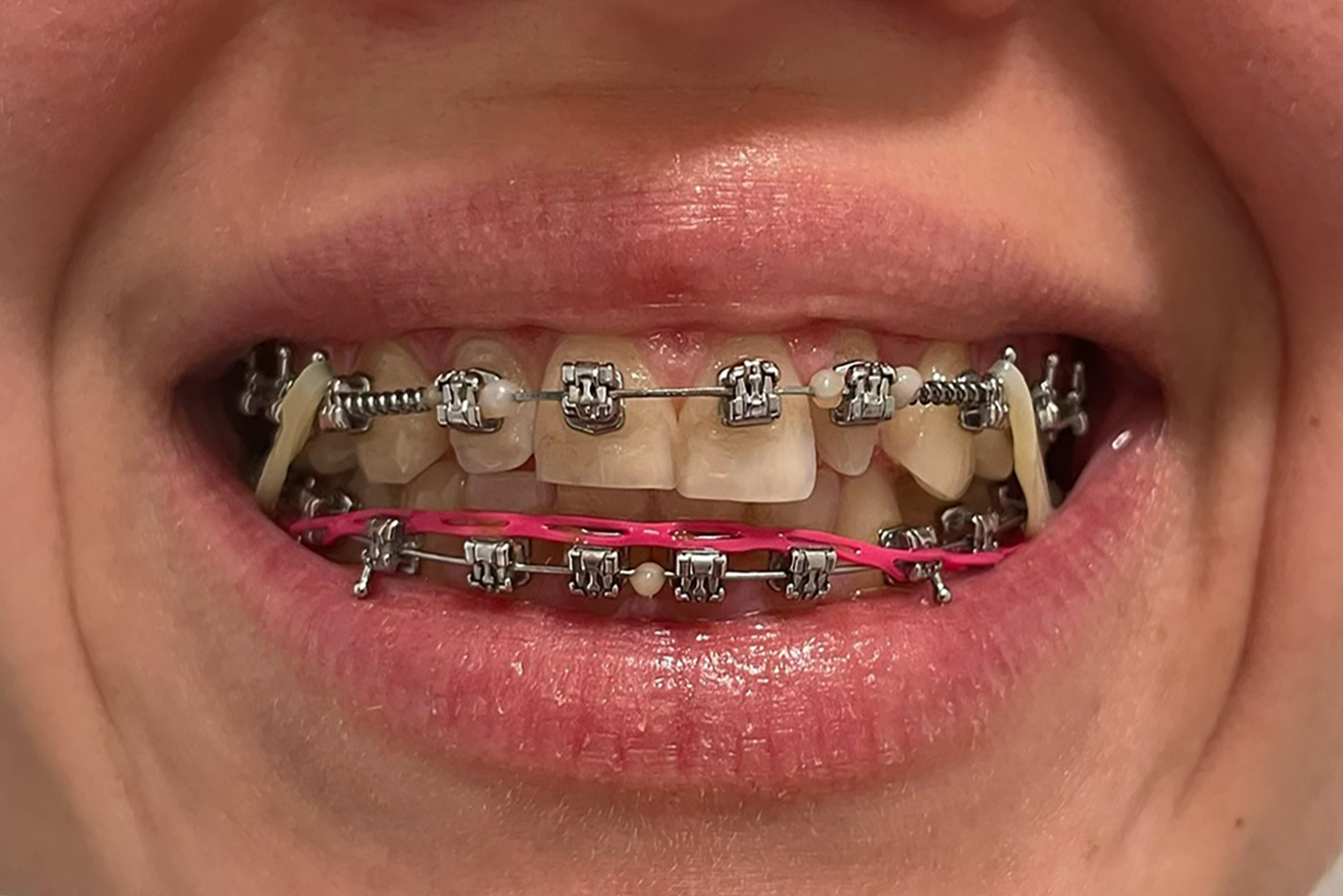 Последний снимок. На зубах брекеты с пружинами, эластики и ортодонтическая цепочка