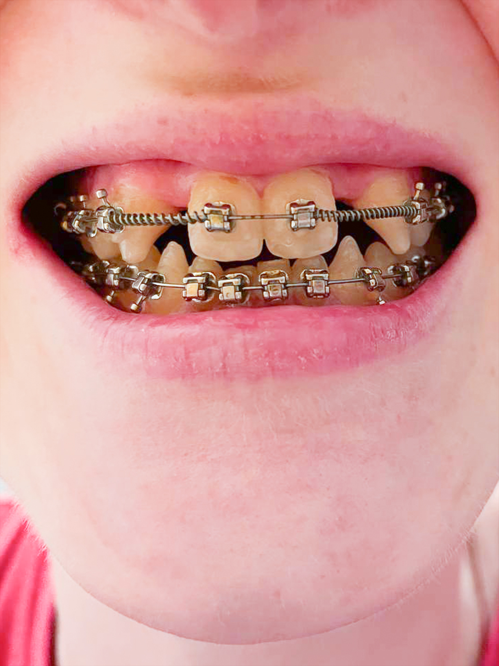 Зубы с брекетами через шесть месяцев с начала лечения. Фото до коррекции нет, потому что улыбалась я мало