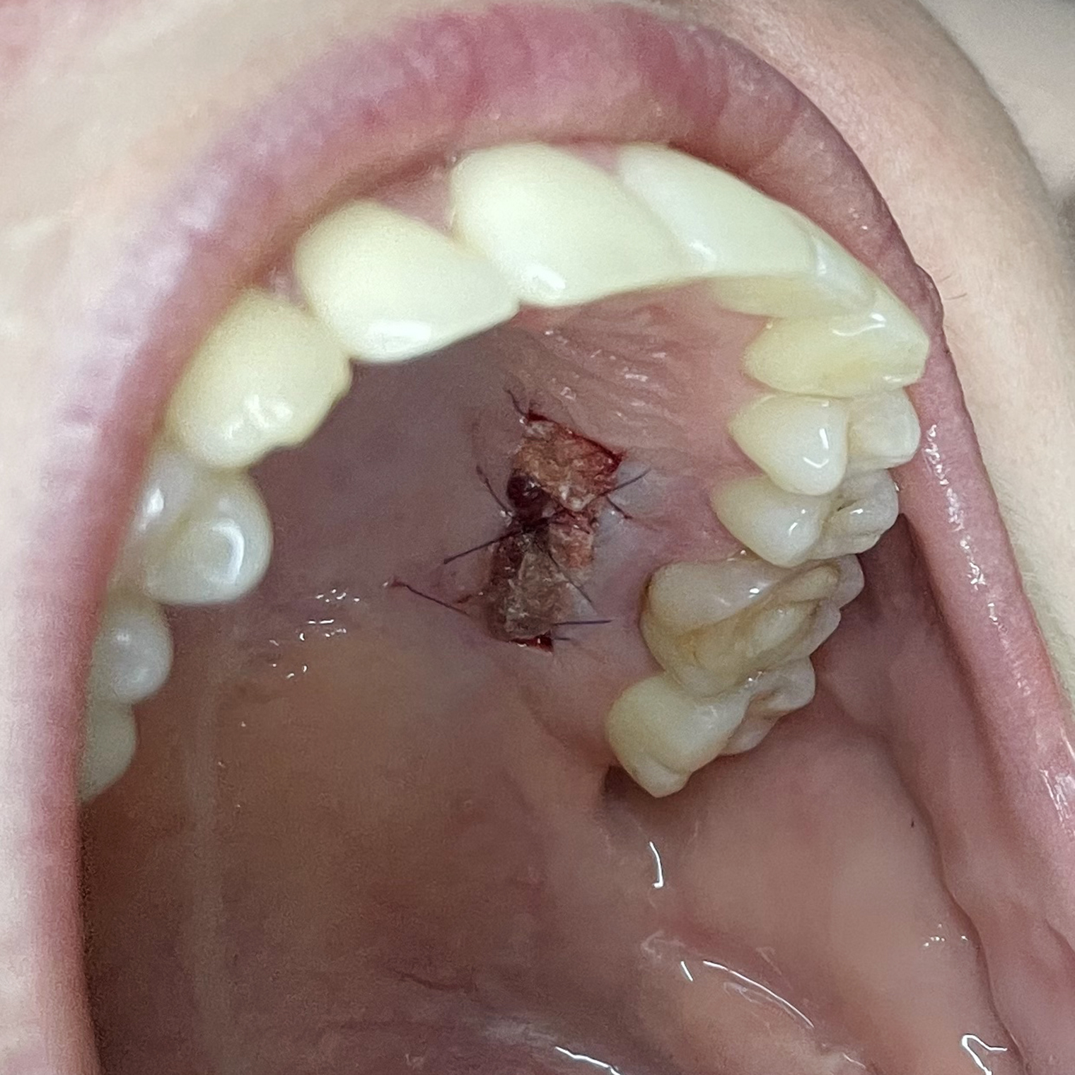 Рана после пластики десны