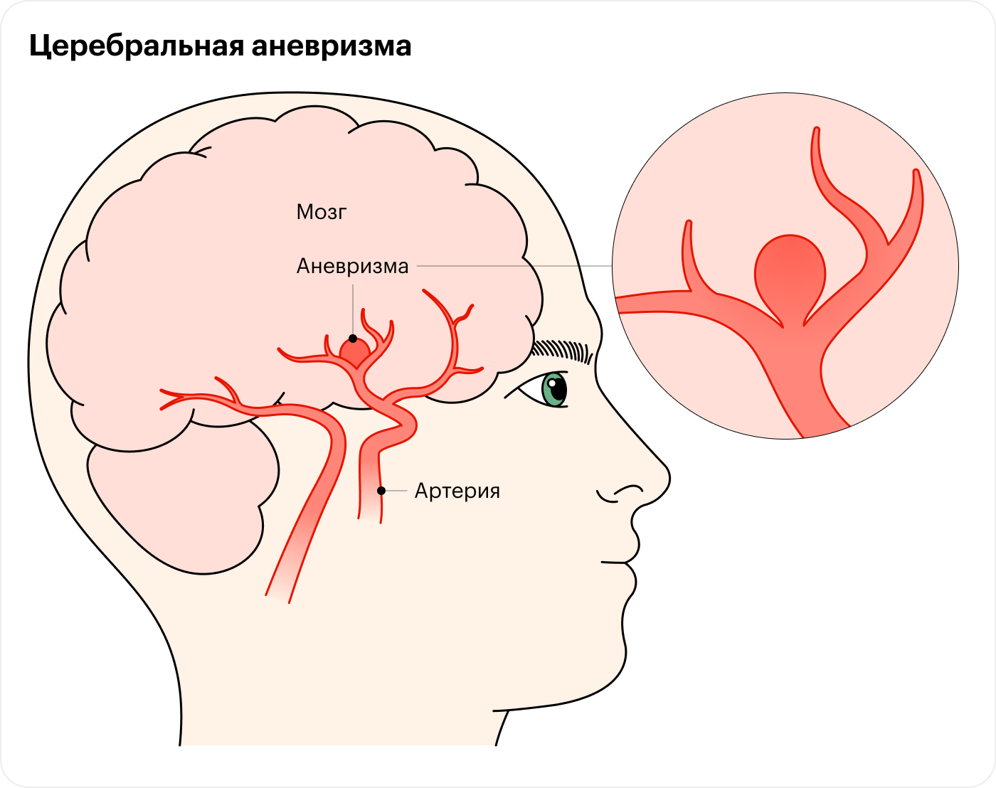 Аневризма мозга отзывы. Базальная церебральная аневризма. Давление аневризмы на печень.