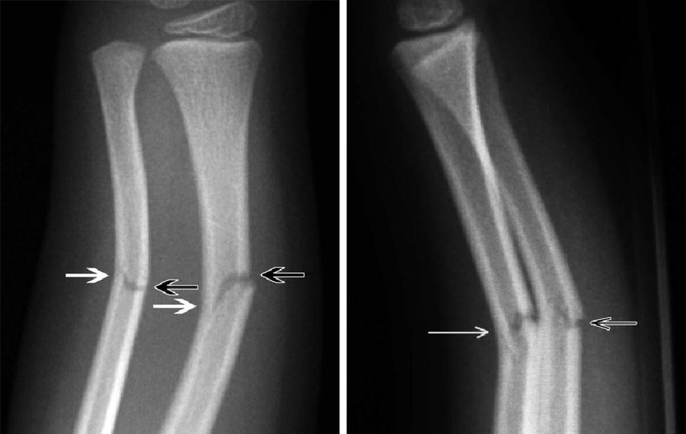 Перелом по типу «зеленой ветки», когда кость не разламывается на две части. Источник: researchgate.net