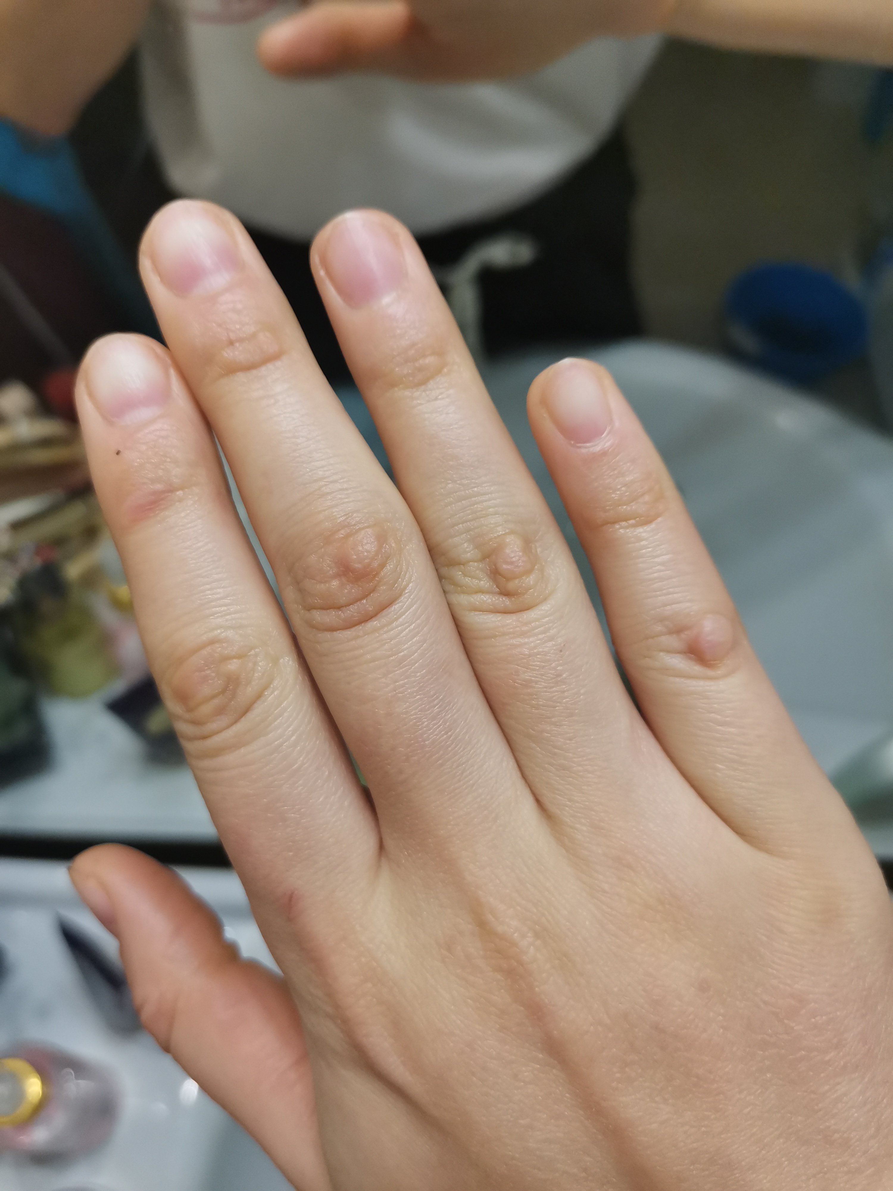 На пальце появилась шишка: это болезнь?