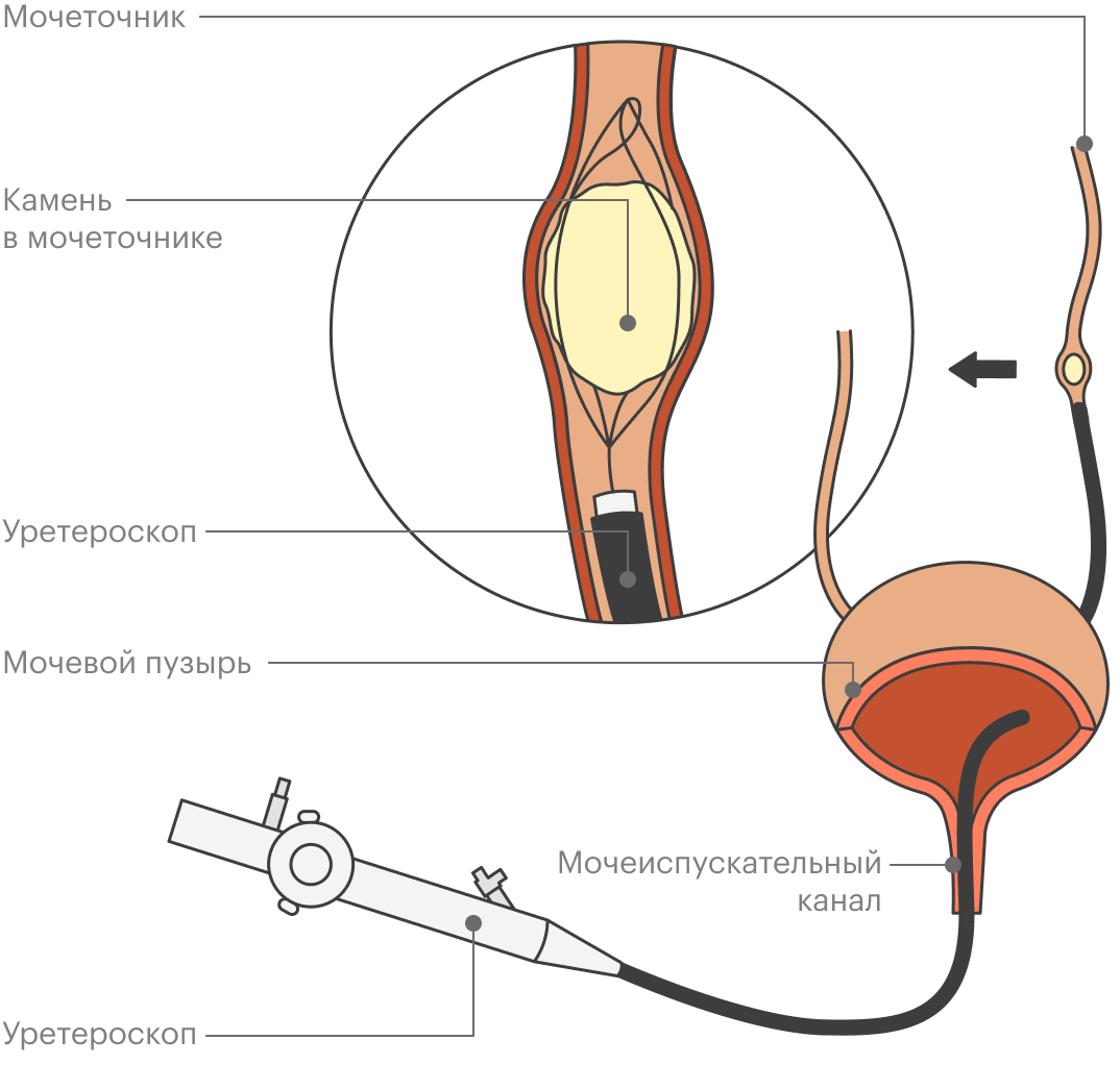 При уретероскопии камень удаляют или разрушают с помощью эндоскопического прибора, который вводят через мочеиспускательный канал