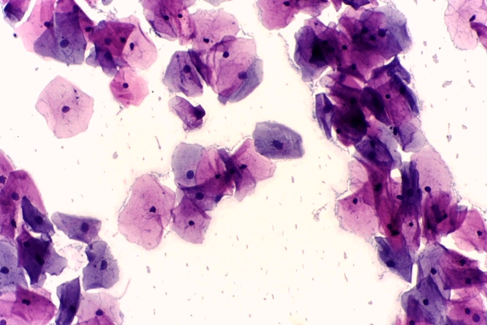 Здоровые клетки эпителия шейки матки под микроскопом выглядят примерно так. Источник: Википедия