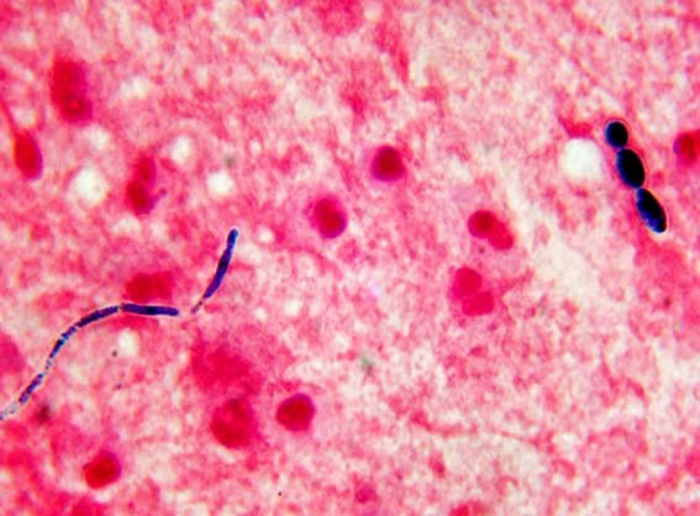 Candida albicans в окрашенном мазке под микроскопом. Справа — три круглых взрослых дрожжевых гриба, слева — цепочка из удлиненных делящихся дрожжевых грибов. Источник: thunderhouse4-yuri