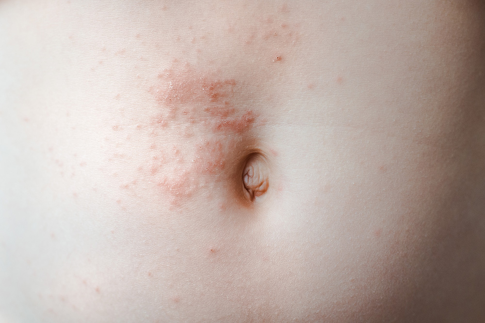 Сыпь может быть аллергической, но на месте доказать свою правоту поможет только справка. Источник: Juliya Shangarey / Shutterstock