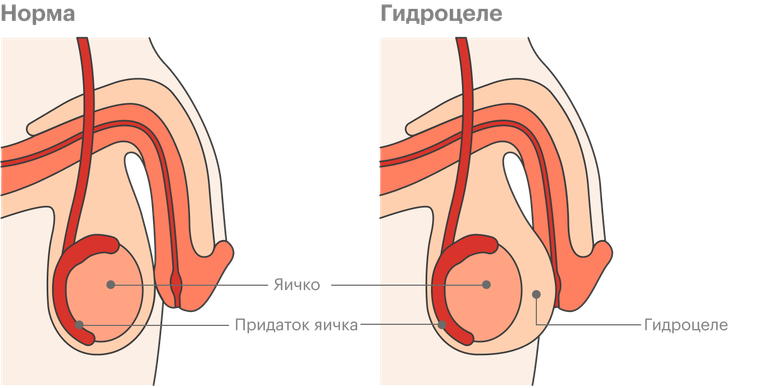Что значит водянка яичка у детей