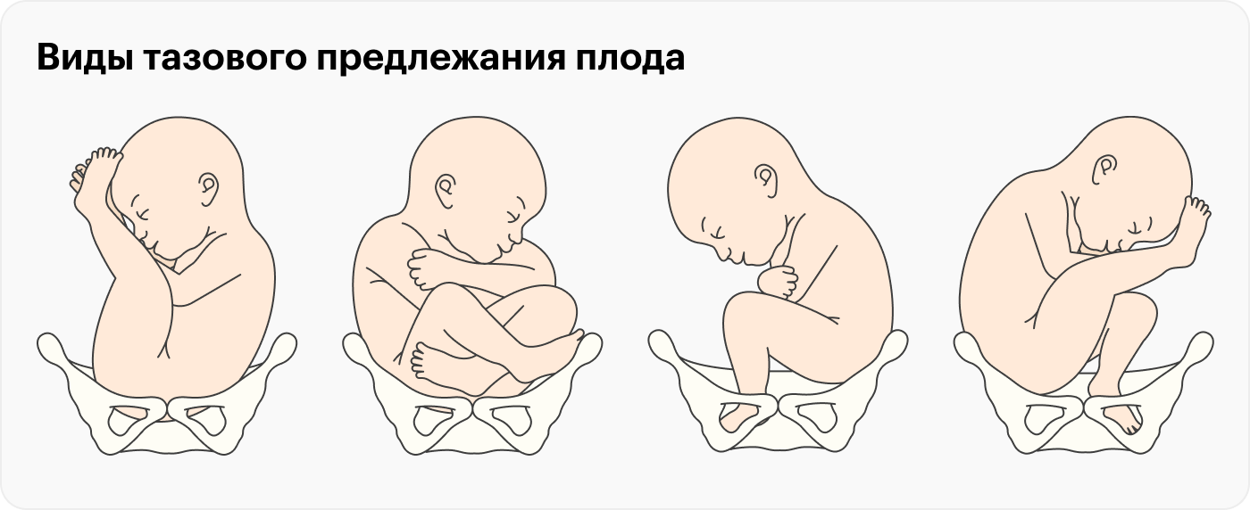 Первые роды через естественные родовые пути возможны при тазовом предлежании только в том случае, если младенец лежит в первом положении: точно ягодицами вниз с вытянутыми вверх вдоль тела ногами