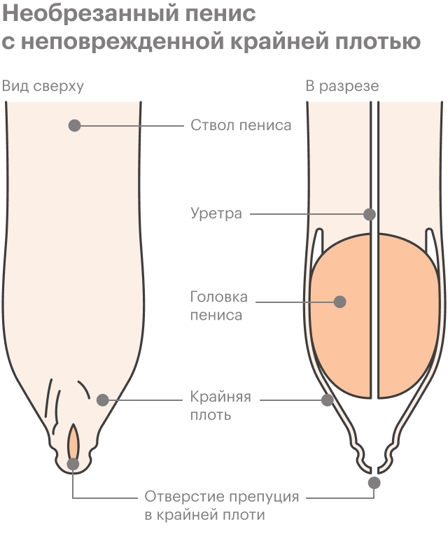 Баланопостит у детей