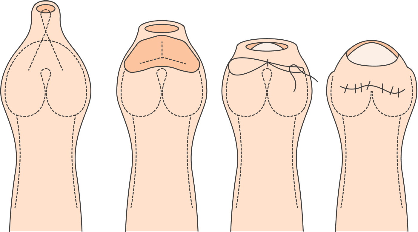 Один из вариантов препуциопластики — YV⁠-⁠пластика, при которой на нижнем конце крайней плоти делается Y⁠-⁠образный разрез, который затем ушивается. Таким образом увеличивается отверстие для головки пениса