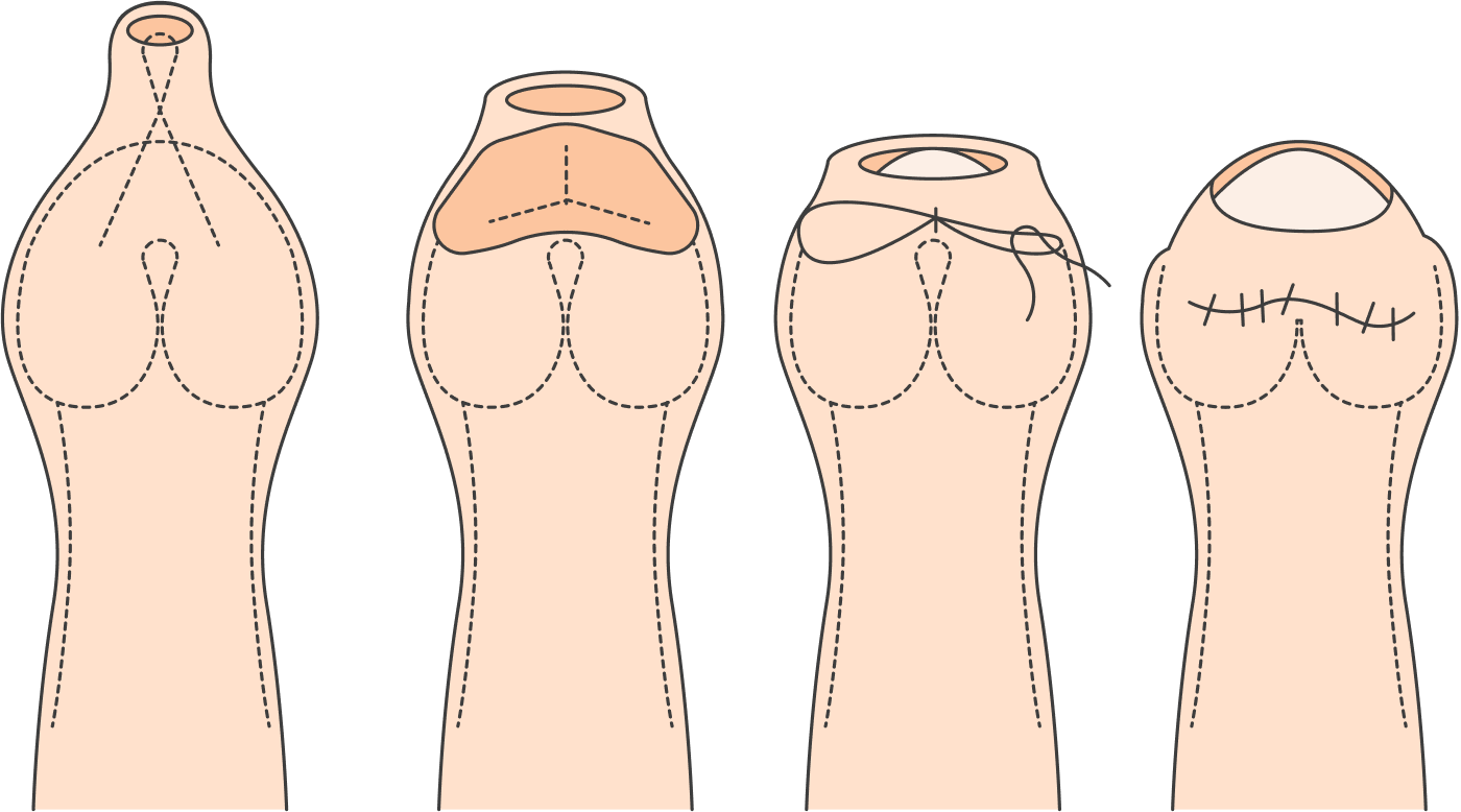 Мужчина открывает головку. Обрезание схема операции. Схема обрезания крайней плоти.