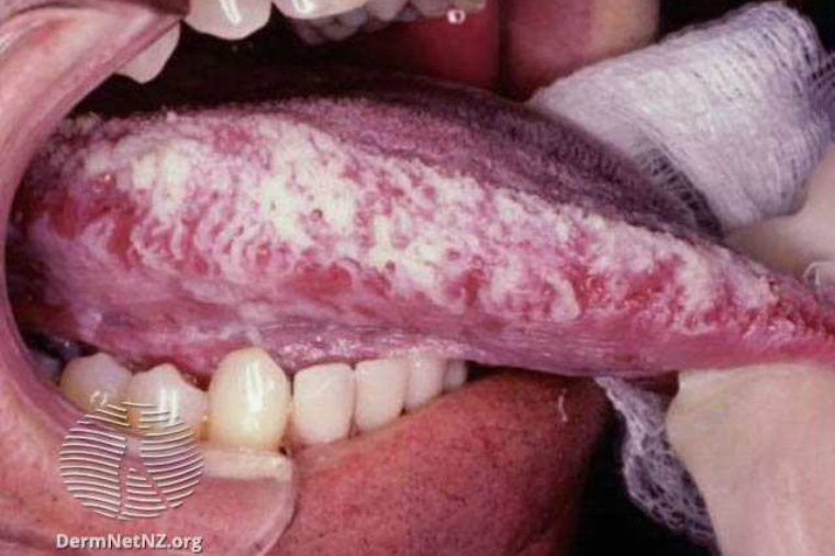 Белый налет на языке при лейкоплакии. Источник: dermnetnz.org