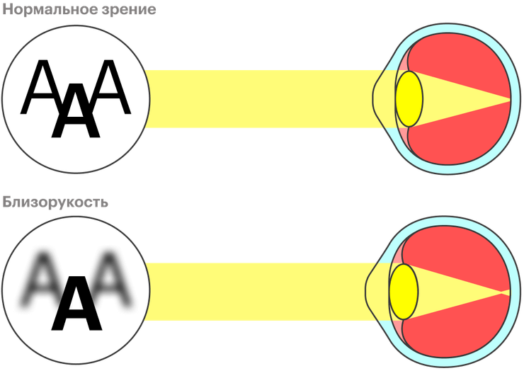 Что делать, если стремительно падает зрение?