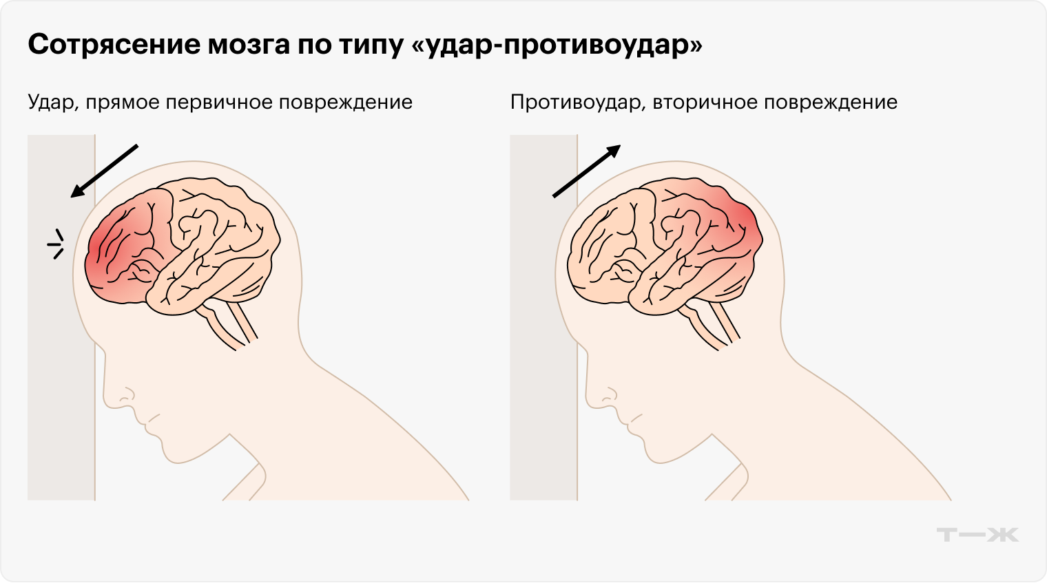 Головной мозг травмируется как из-за самого удара, так и оттого, что «отскакивает» и ударяется о противоположную стенку черепа