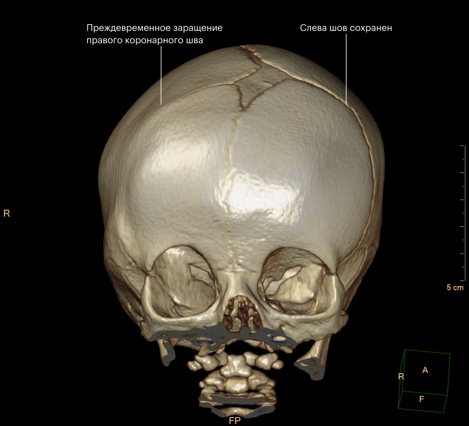 КТ костей черепа с 3D⁠-⁠реконструкцией. Заращение правого коронарного шва и уплощение лба с этой стороны. Источник: radiopaedia.org