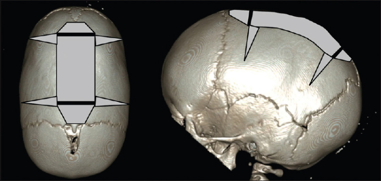 Схема операции при сагиттальном краниосиностозе. Черные линии обозначают разрезы кожи, серым цветом указаны участки, в которых удаляют кости. Источник: «Международная хирургическая неврология»