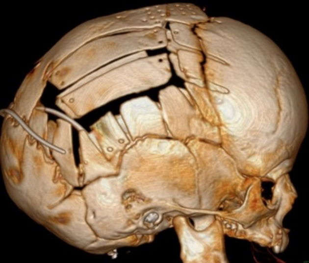 КТ черепа после реконструктивной операции по поводу сагиттального краниосиностоза. Источник: онлайн-библиотека Nexus