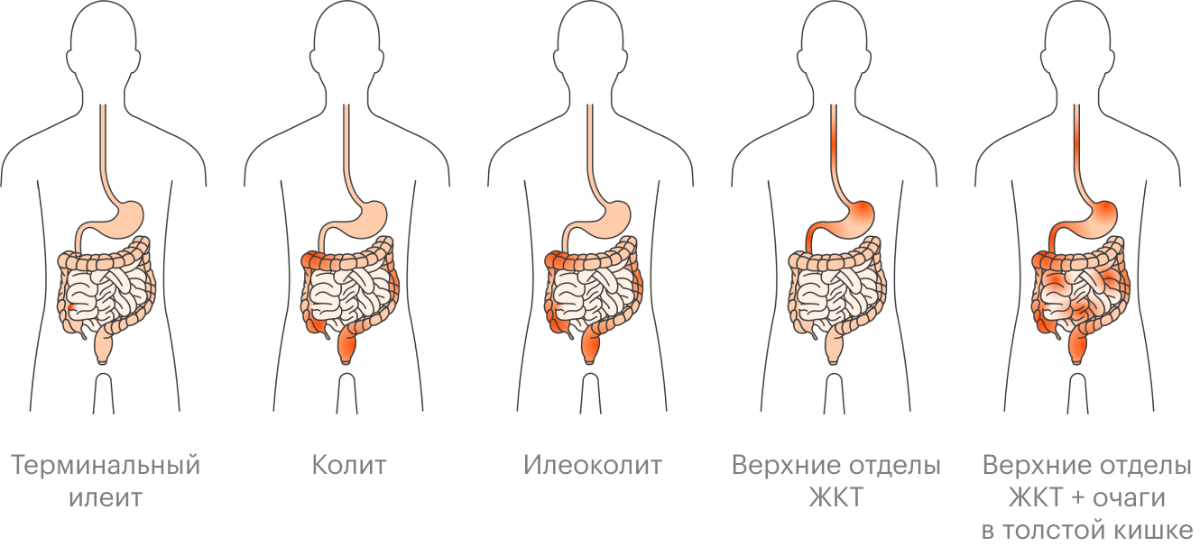 Поражение разных отделов желудочно-кишечного тракта при болезни Крона