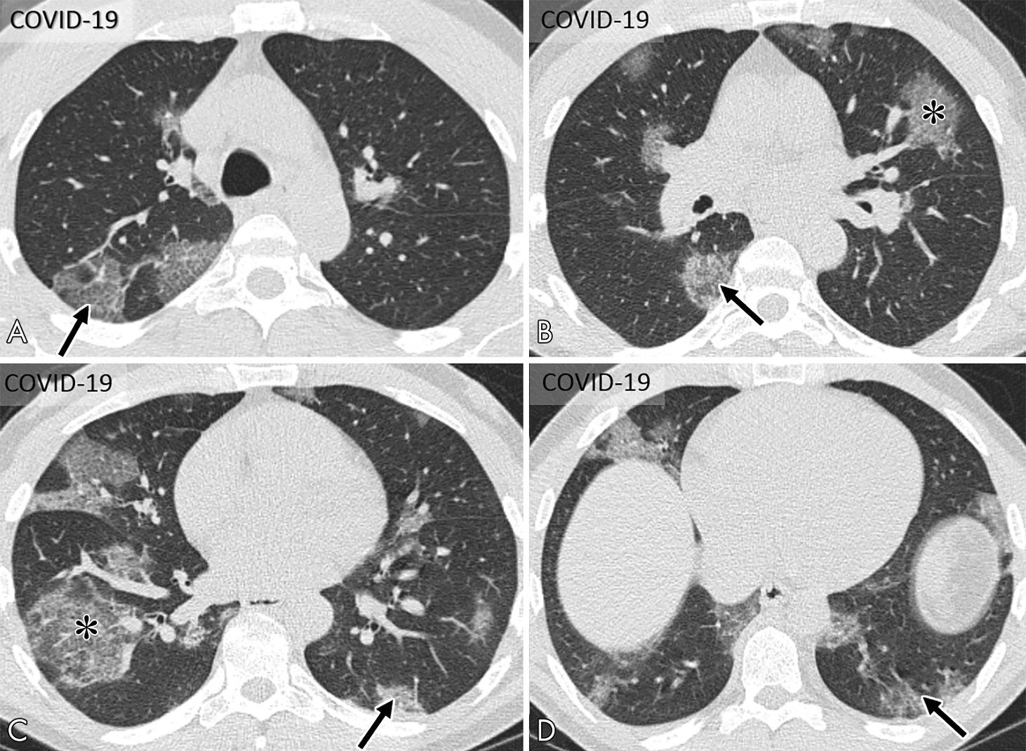 КТ-изображение нескольких «ломтиков» грудной клетки. Звездочки и стрелки указывают на поражения, которые могут свидетельствовать о коронавирусной болезни. Источник: RSNA