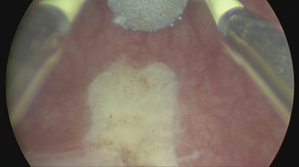 Так выглядит лейкоплакия мочевого пузыря на цистоскопии
