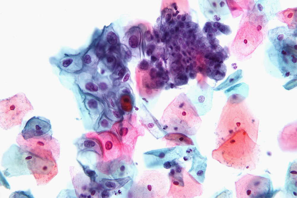 Мазок по Папаниколау под микроскопом. Крупные розовые эпителиальные клетки нормальные, а мелкие сине-фиолетовые могут оказаться предраковыми. Scienceline