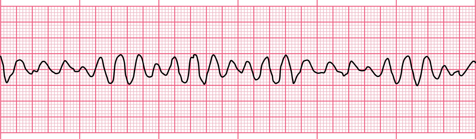 Тяжелая аритмия, при которой дефибриллятор поможет: сердце не работает, но электрическая активность в нем есть, мышечные волокна хаотично сокращаются. Фото: Alfa MD / Shutterstock