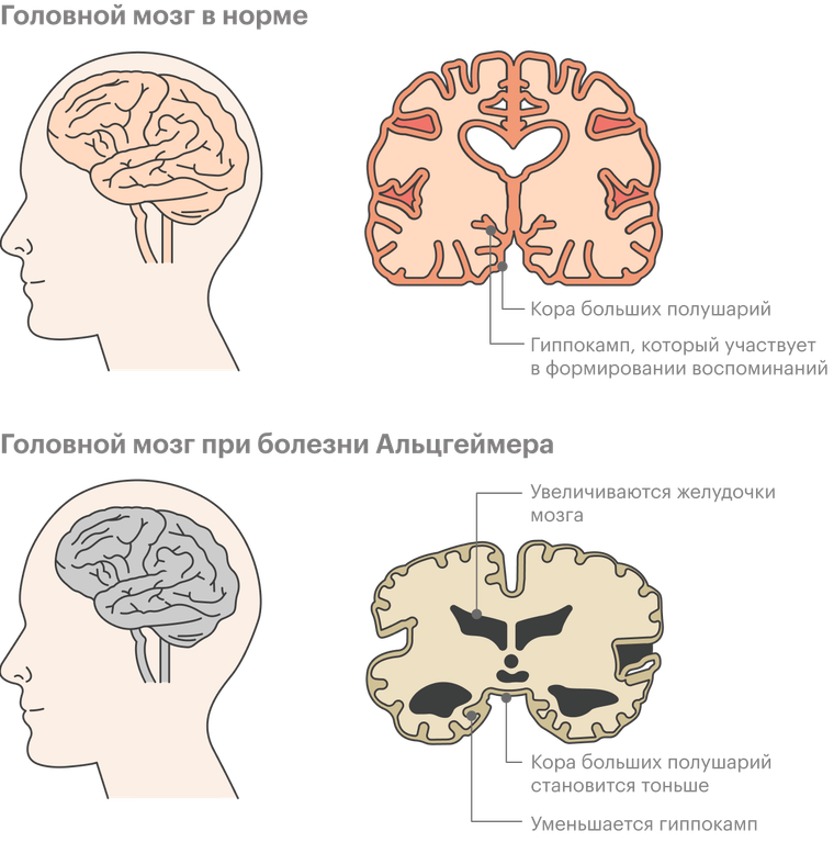 «Поддерживайте общение» – невролог рассказала, как вести себя с человеком с болезнью Альцгеймера