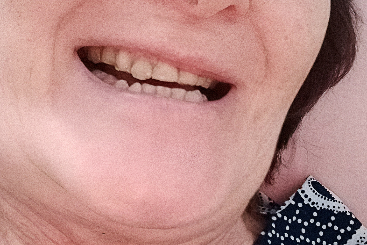 Имплант с коронкой — в верхнем зубном ряду, четвертый справа от центра