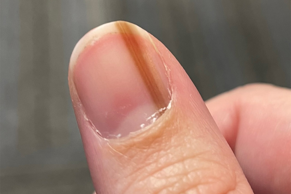 Так может выглядеть меланома под ногтевой пластиной. Источник: today.com