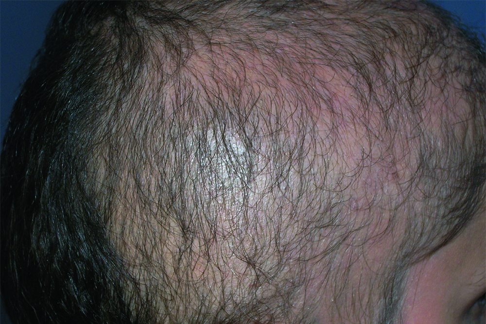 Люди с трихотилломанией из⁠-⁠за своего расстройства даже могут облысеть. Источник: msdmanuals.com