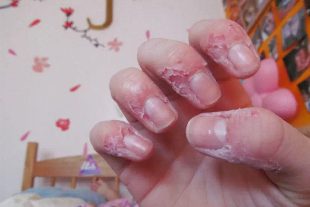 Так могут выглядеть руки человека с дерматофагией. Источник: evrimagaci.org