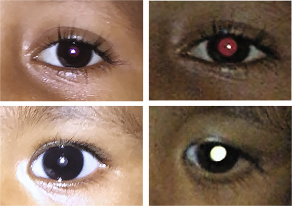 Верхний ряд фотографий — нормальный глаз, при фотосъемке отблеск будет красным. Нижний ряд — глаз с ретинобластомой, отблеск зеленоватый, без красного оттенка. Источник: Nature