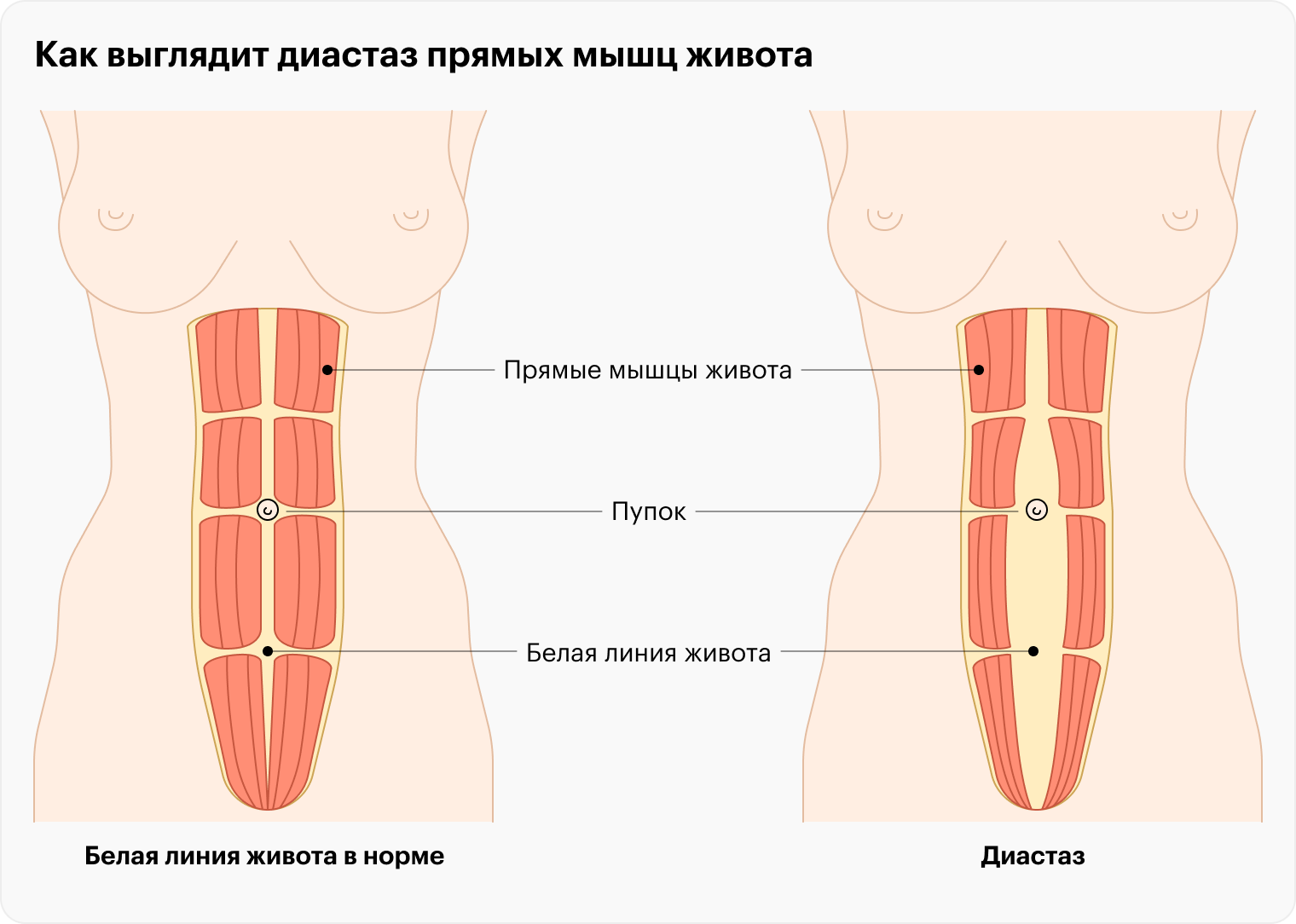 При диастазе происходит аномальное расхождение прямых мышц живота. Оно может быть над пупком, под ним, или сверху и снизу пупка одновременно