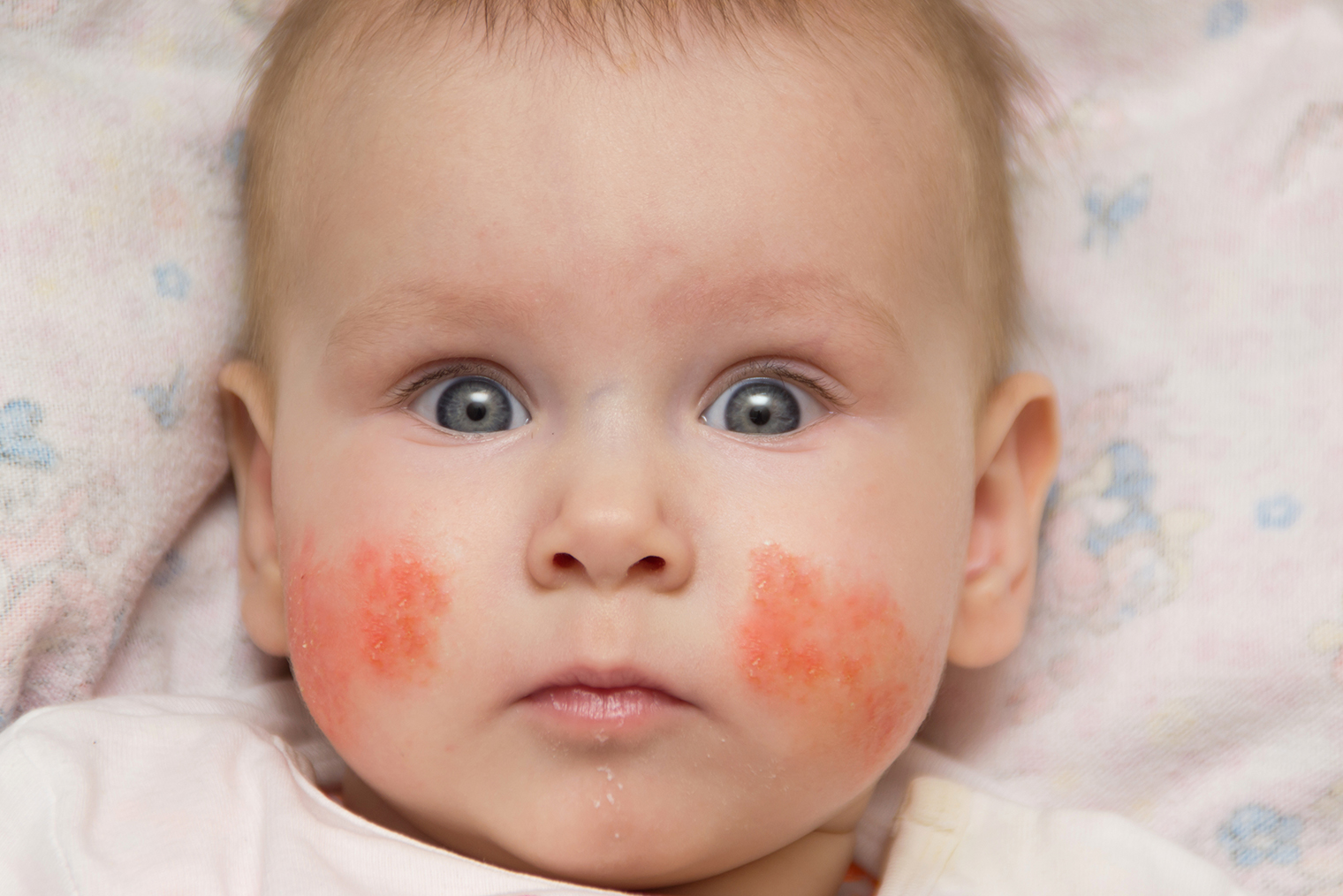 Так выглядит атопический дерматит у маленького ребенка. Фотография: alexeisido / Shutterstock