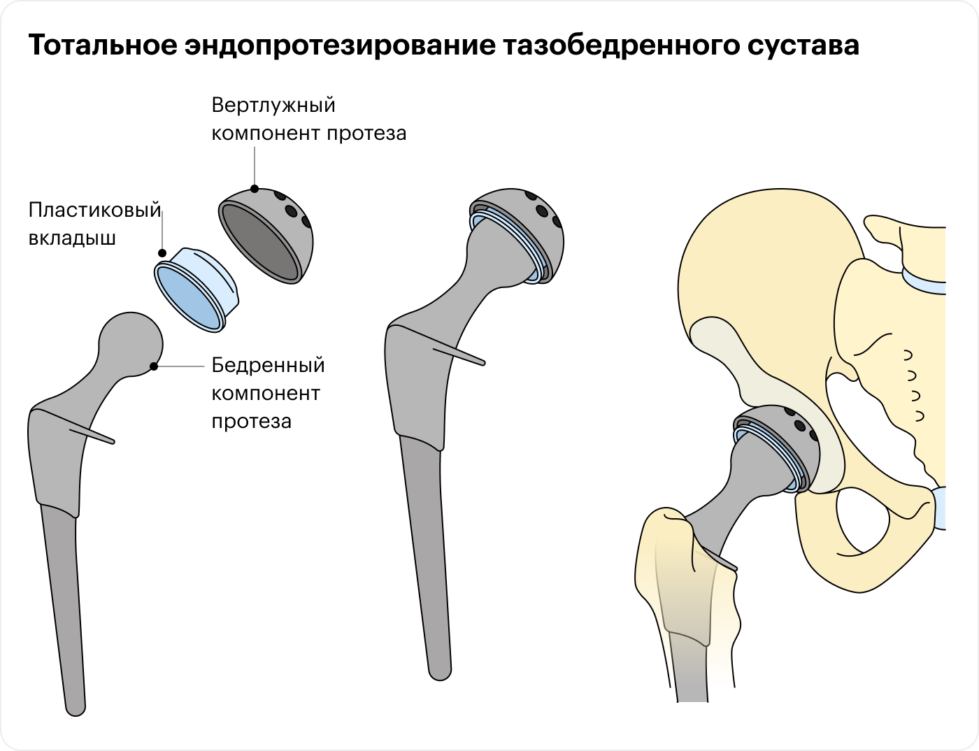 Эндопротезирование тазобедренного сустава. Биполярный протез тазобедренного сустава. Как выглядит протез тазобедренного сустава. Конструкция протеза тазобедренного сустава.