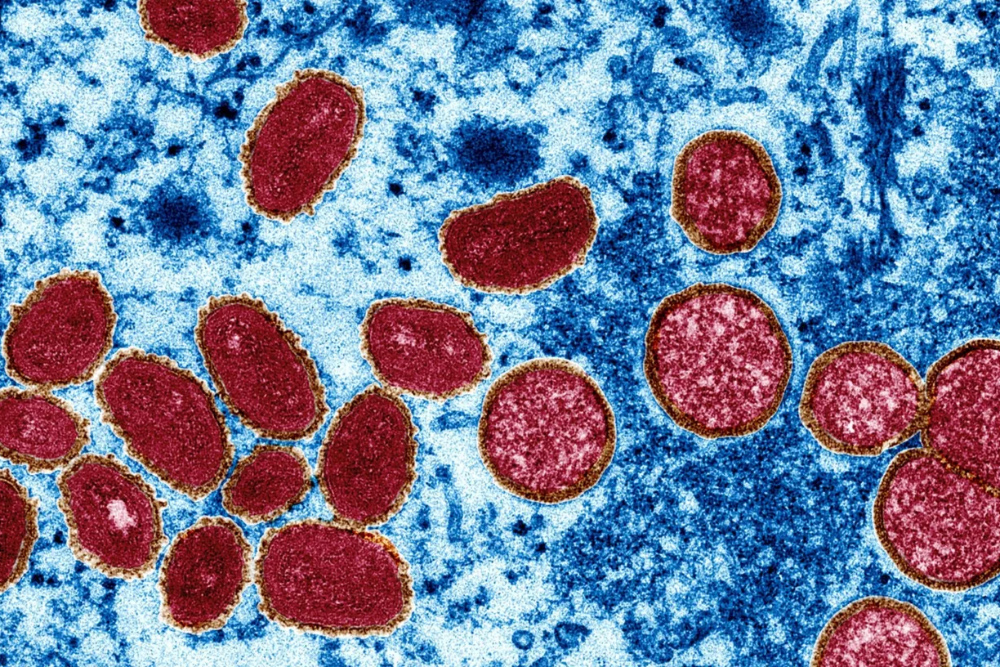 Так выглядят вирусы оспы обезьян в коже человека под микроскопом. Слева — зрелые экземпляры овальной формы. Справа — сферические незрелые вирусы. Источник: nationalgeographic.co.uk
